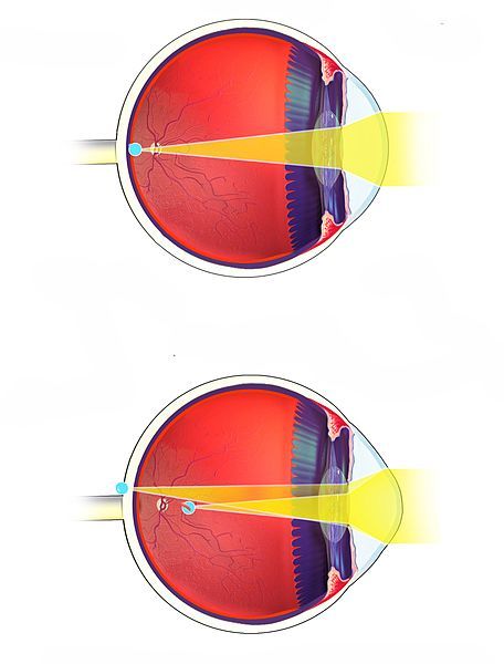 File:Astigmatism.jpg