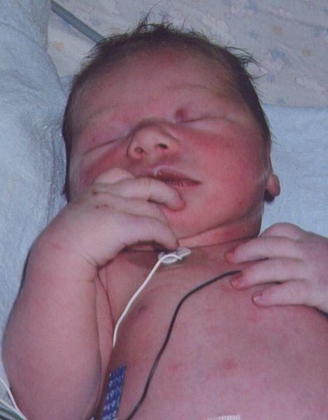 File:Cyanotic neonate.jpg