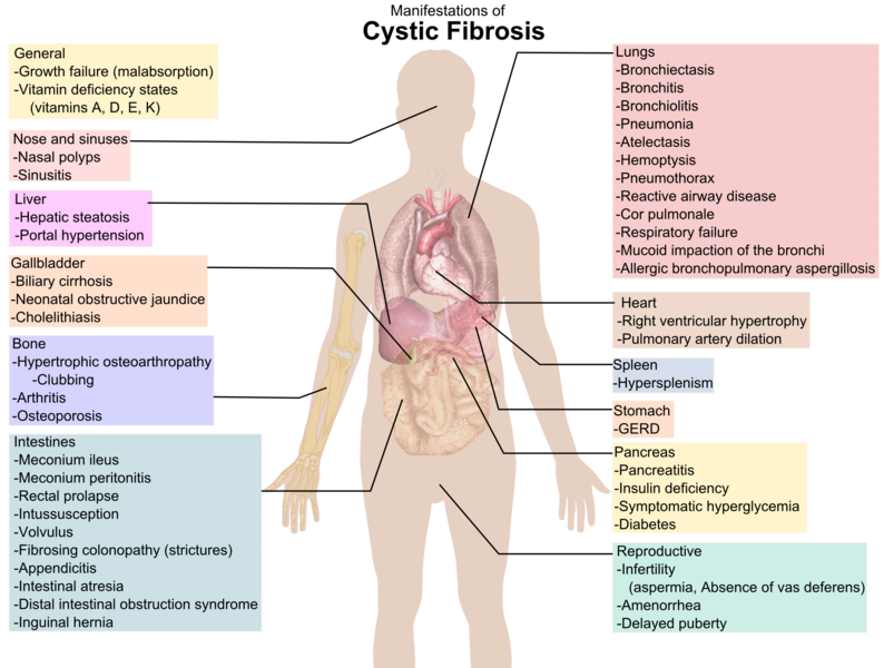 File:Cystic fibrosis manifestations.png