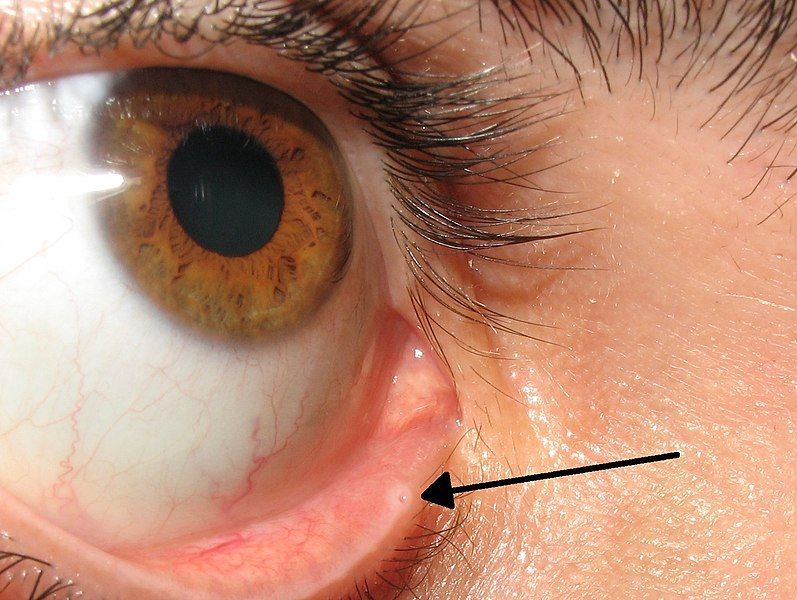 File:Lacrimal punctum.jpg