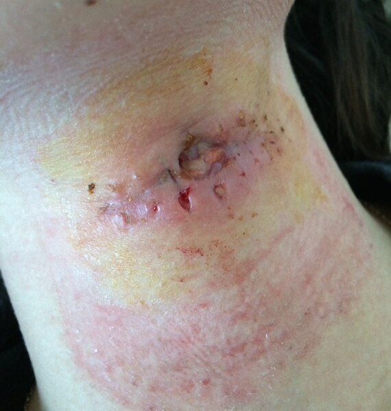 File:Post stitches infection.jpg