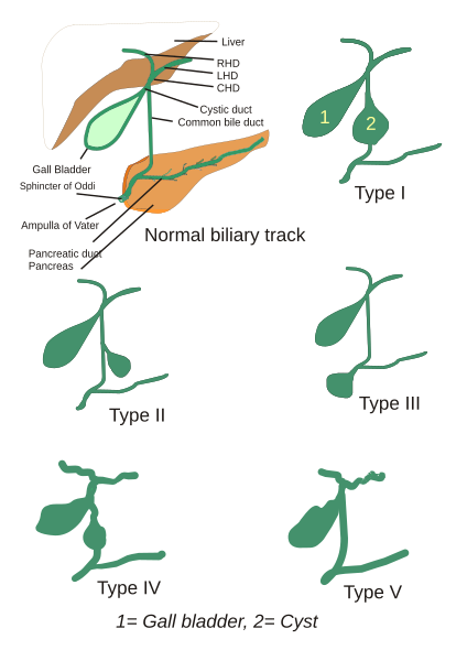 File:Choledochal cysts.svg