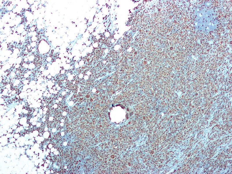 File:Xanthogranulomatous pyelonephritis cd68.jpg