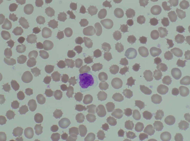 File:Acanthocytosis.jpg