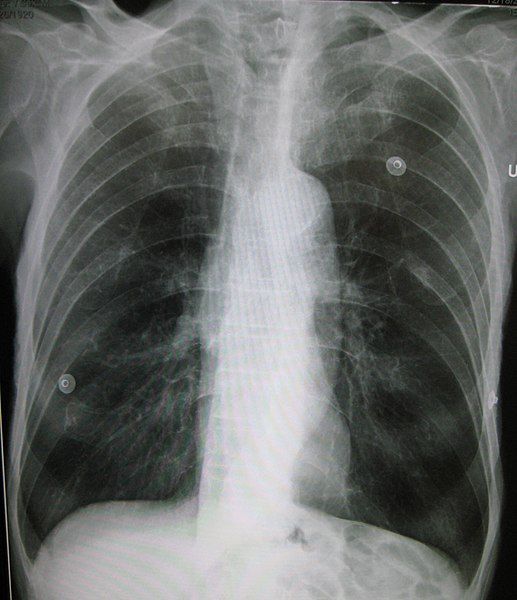 File:Emphysema2008.jpg