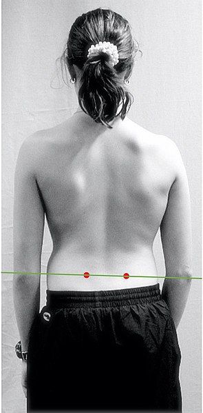 File:Scoliosis brace.jpg