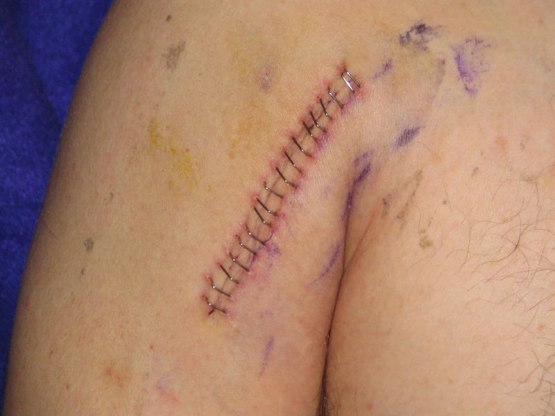 File:Surgical staples1.jpg