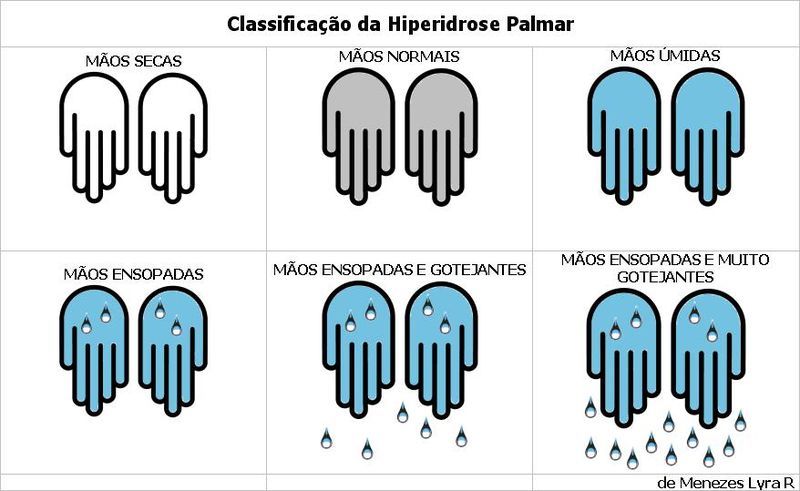 File:Hiperidrose palmar JPEG.JPG