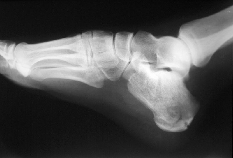 File:Calcaneus Fracture.jpg