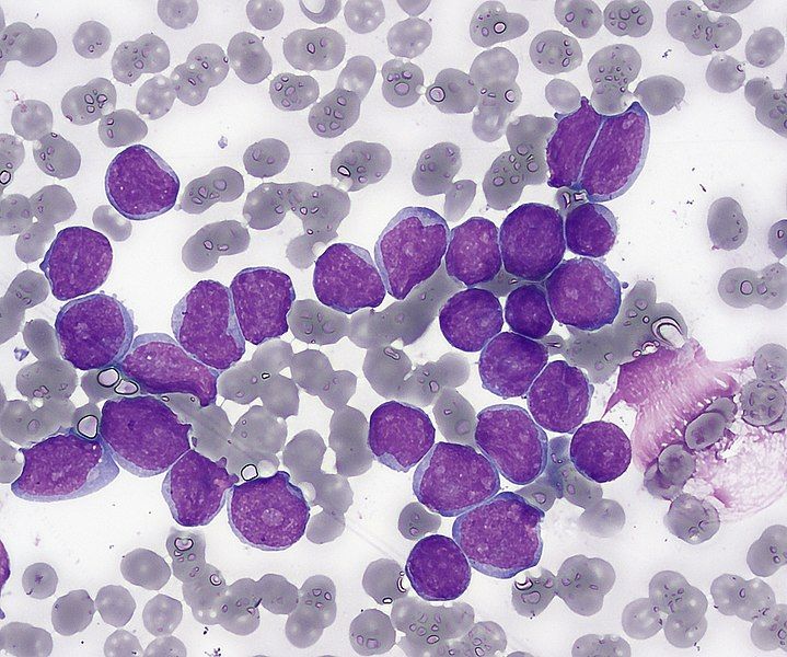 File:Acute lymphoblastic leukemia.jpg