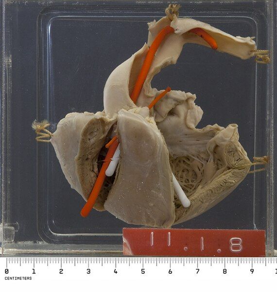 File:PLC Fallots tetralogy.jpg