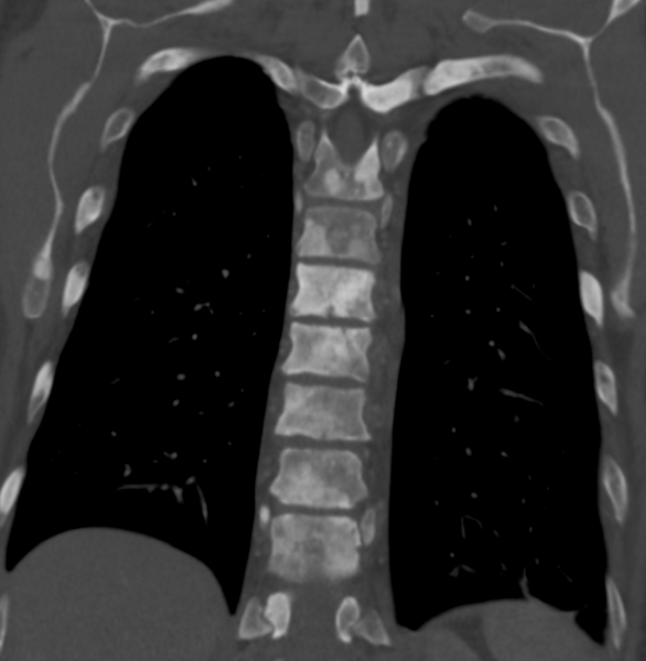 File:Scleroticmetastaticdiseasespine.png