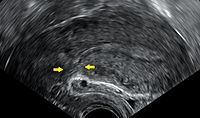 Uterus after Caesarean section