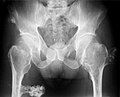 multiple osteochondromas at the pelvis