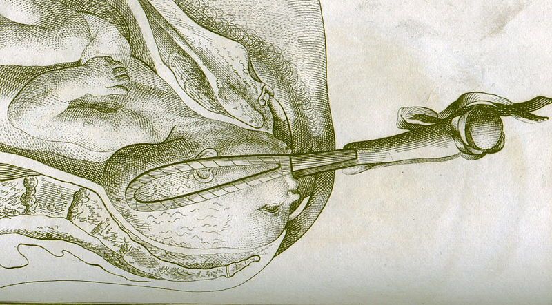 File:Forceps.Smellie.jpg