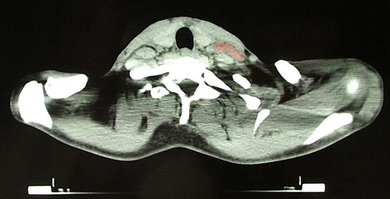 File:Hodgkin Lymphoma CT2.jpg