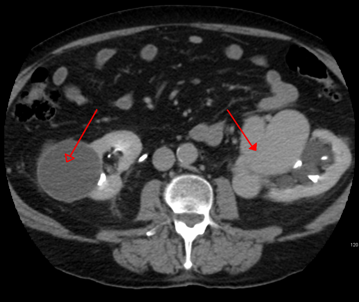 File:PleftkidneyAVM1.png