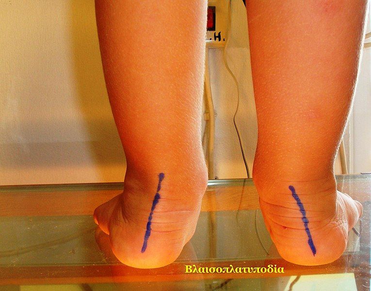 File:Flat feet (1).jpg