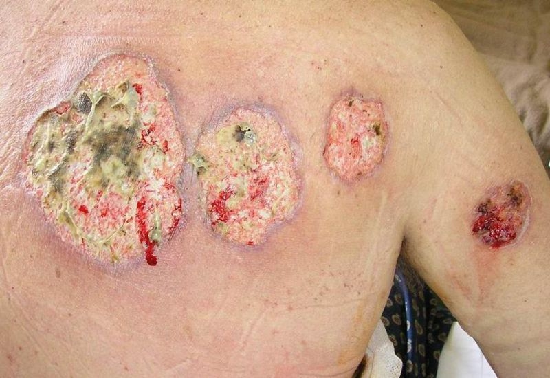 File:Pyoderma gangrenosum 01.jpg