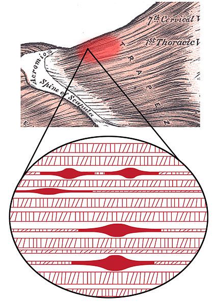 File:Trigger Point Complex.jpg