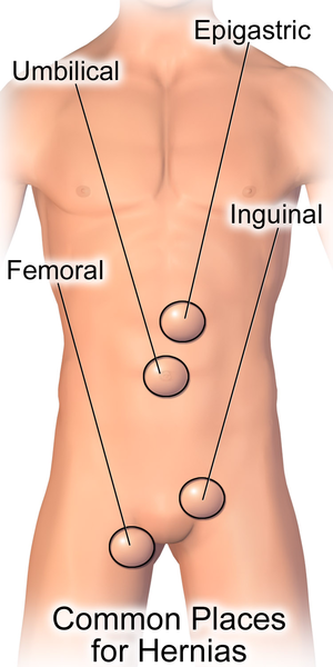 File:Hernia Common Sites.png