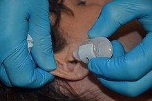 a photo of a medical professional administering ear drops