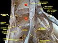 Lumbar and sacral plexus. Deep dissection. Anterior view.