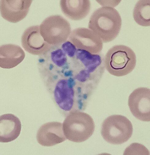 File:Green neutrophilic inclusions.jpg