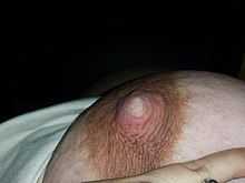 A photo showing a nipple and areola. A small region at the middle of the nipple pore is lighter in colour, indicating a reduced blood flow(vasospasm). Nipple blanching is a symptom of poor positioning and latching in breastfeeding.