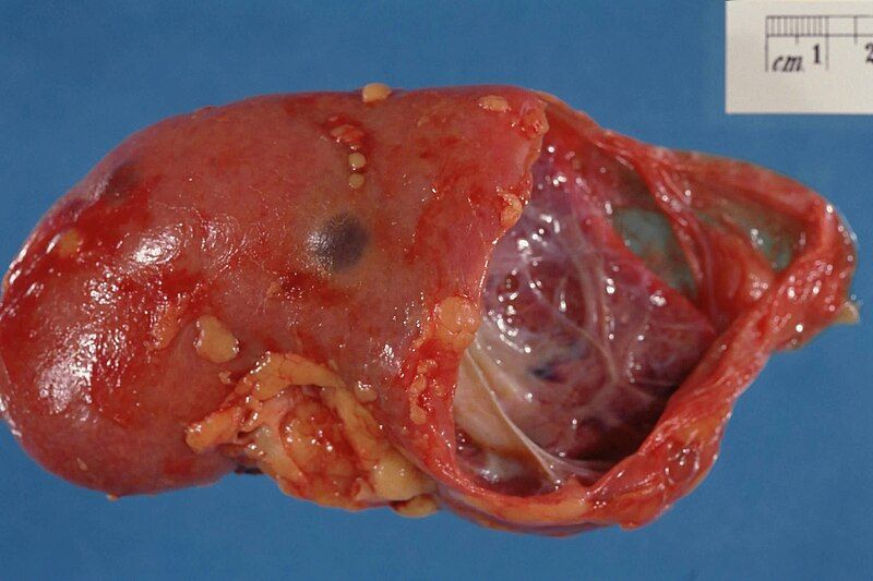 File:Simple cyst, kidney.jpg