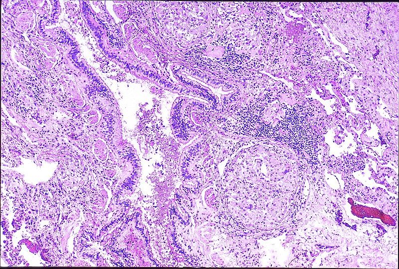 File:Chronic berylliosis (8054314225).jpg