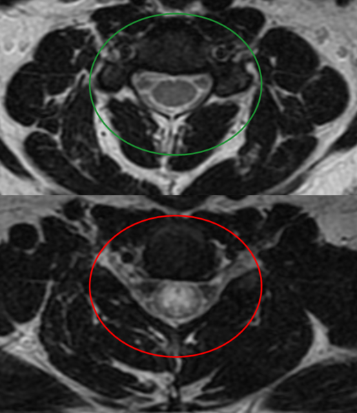 File:Transverse Myelitis.PNG