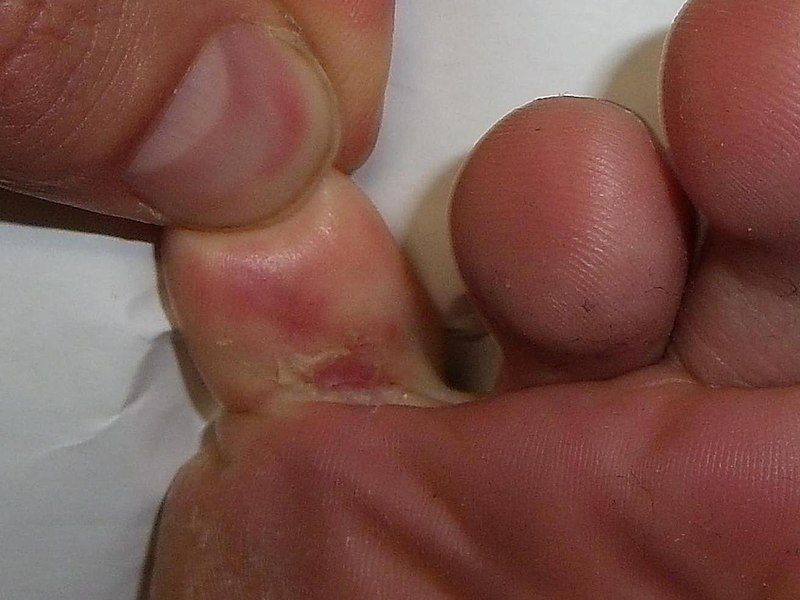 File:Athletes foot.JPG