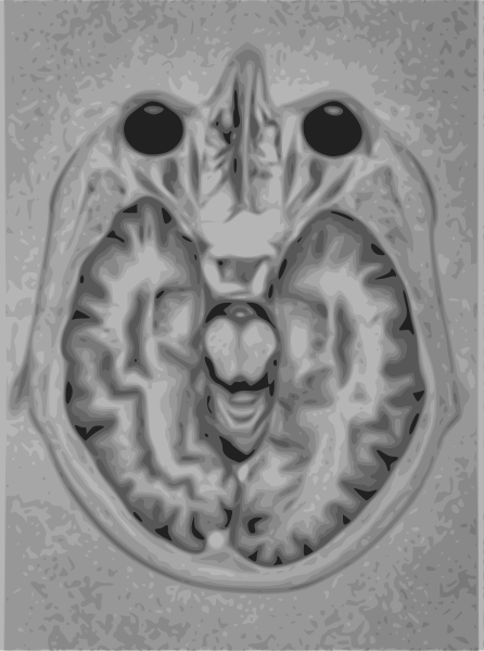 File:Brain Mri nevit.svg