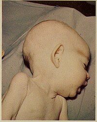 Infant displaying the characteristic symptoms of Donohue syndrome, such as abnormalities in the ears and an oddly shaped cranium.