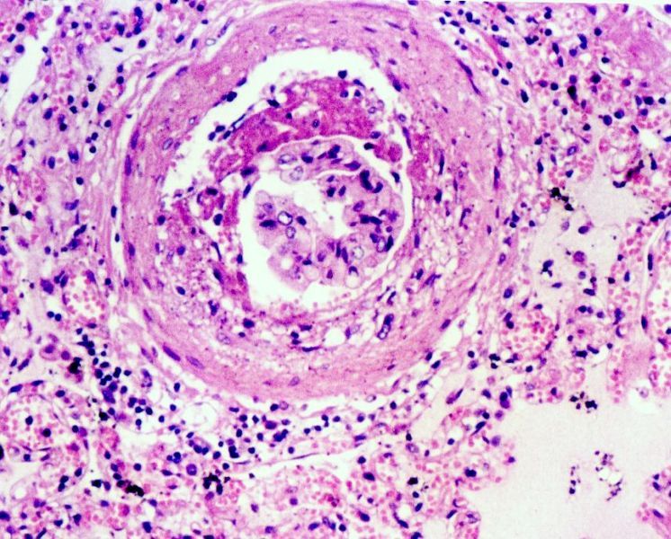 File:Glomeruloesclerosi.1445.jpg