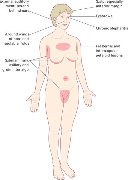 File:Seborrhoeic eczema.png