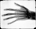 Buckwalter's 1896 X-ray of a hand