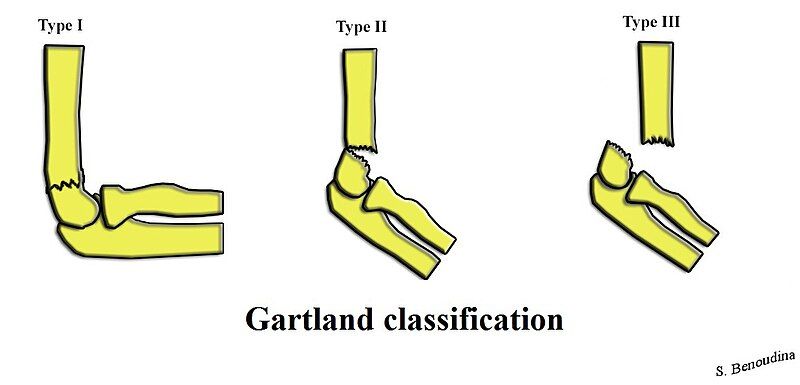 File:Gartland Classification.jpg