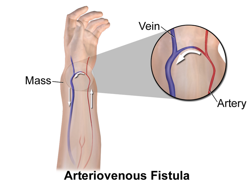 File:Blausen 0049 ArteriovenousFistula.png