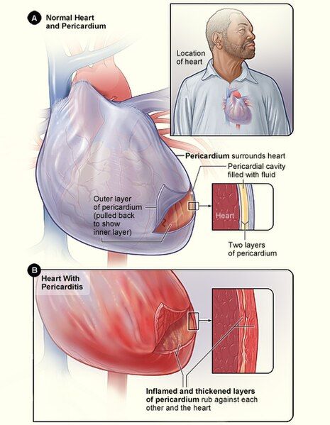 File:Pericarditis.jpg