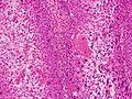 Clear-cell squamous-cell carcinoma